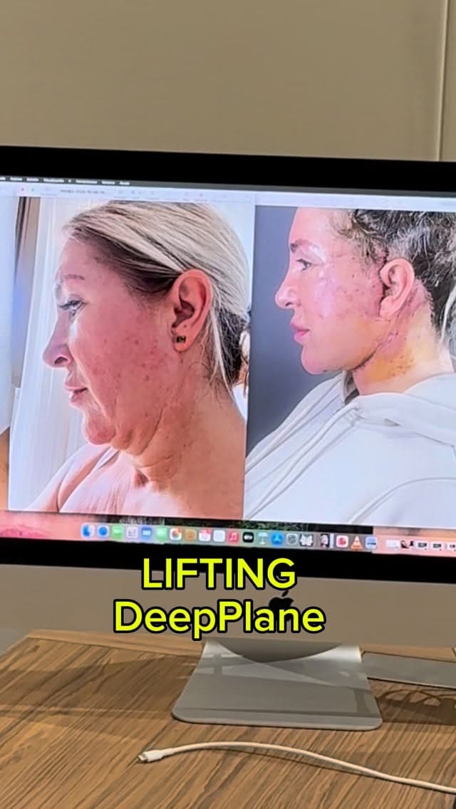 Post 2 by Doctor Mauricio Verbauvede on Instagram (video)