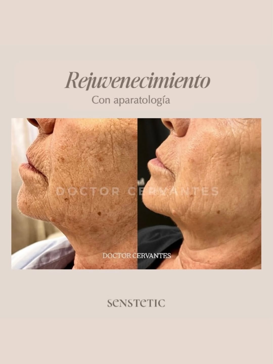 Post 3 by Dr. Cervantes | Médico estético Valencia on Instagram (image)