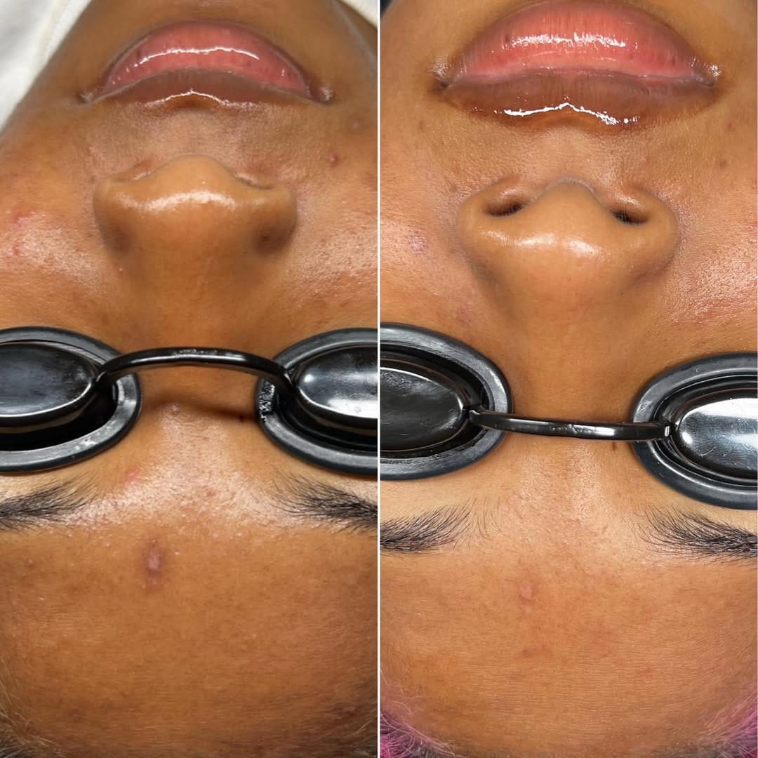 Post 8 by ACNE & CHEMICAL PEEL EXPERT on Instagram (carousel)