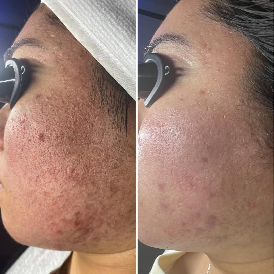 Post 10 by ACNE & CHEMICAL PEEL EXPERT on Instagram (carousel)