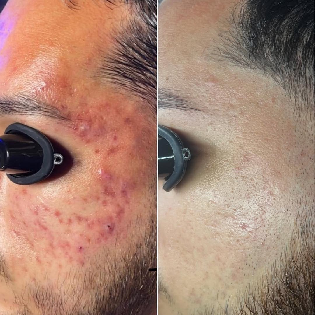Post 9 by ACNE & CHEMICAL PEEL EXPERT on Instagram (carousel)