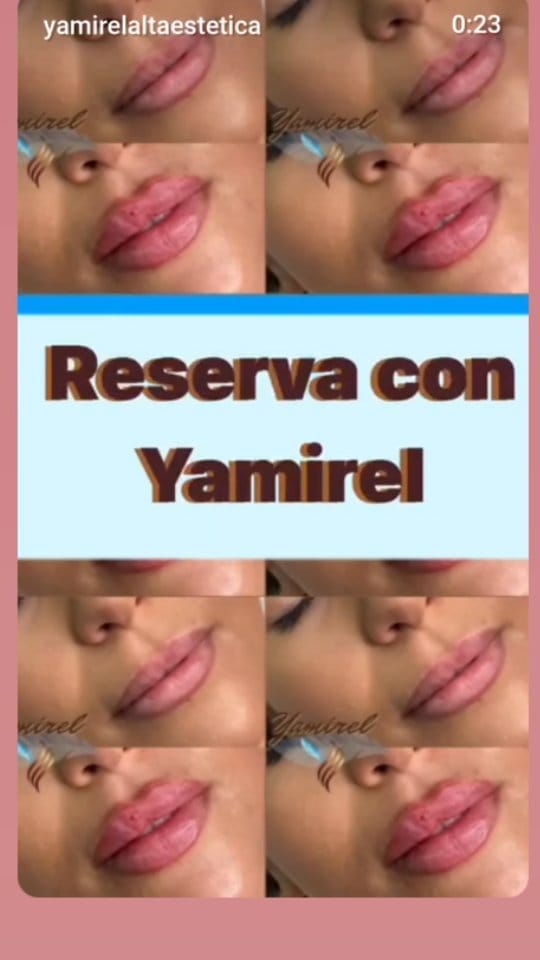 Post 6 by Yamirel Alta Estética | Medicina Estética on Instagram (video)