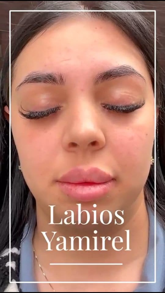 Post 2 by Yamirel Alta Estética | Medicina Estética on Instagram (video)