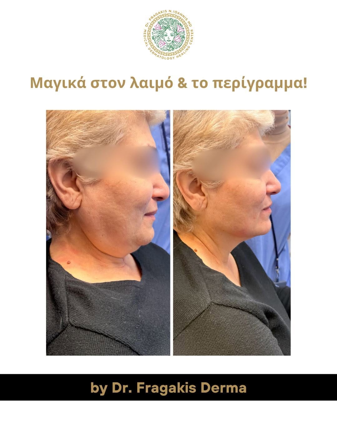 Post 3 by Dr. Fragakis | Δερματολόγος Αφροδισιολόγος MD,MSC on Instagram (carousel)