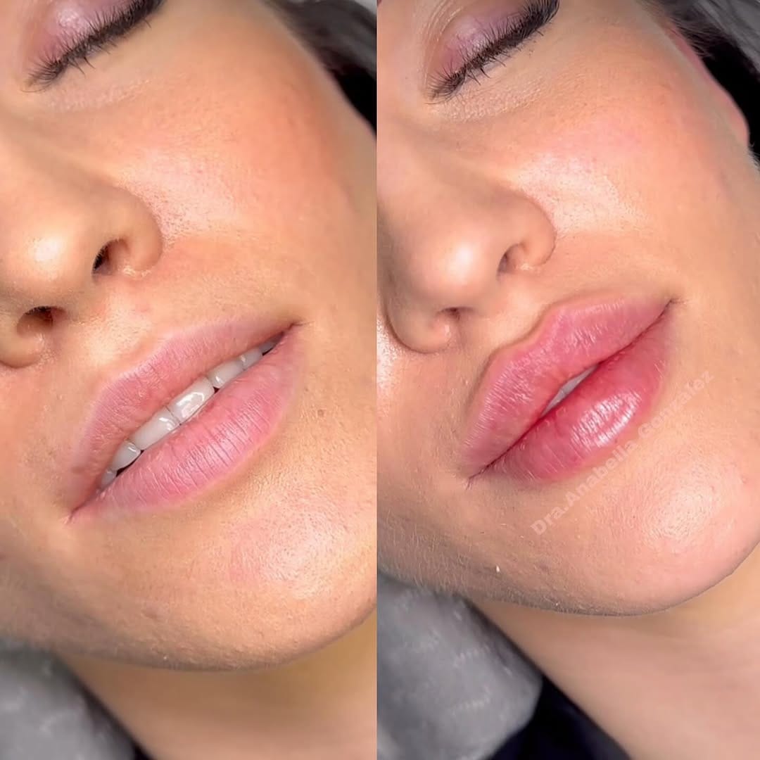 Post 10 by Dra.Anabella González • RUSSIAN LIPS 🇪🇸 on Instagram (carousel)