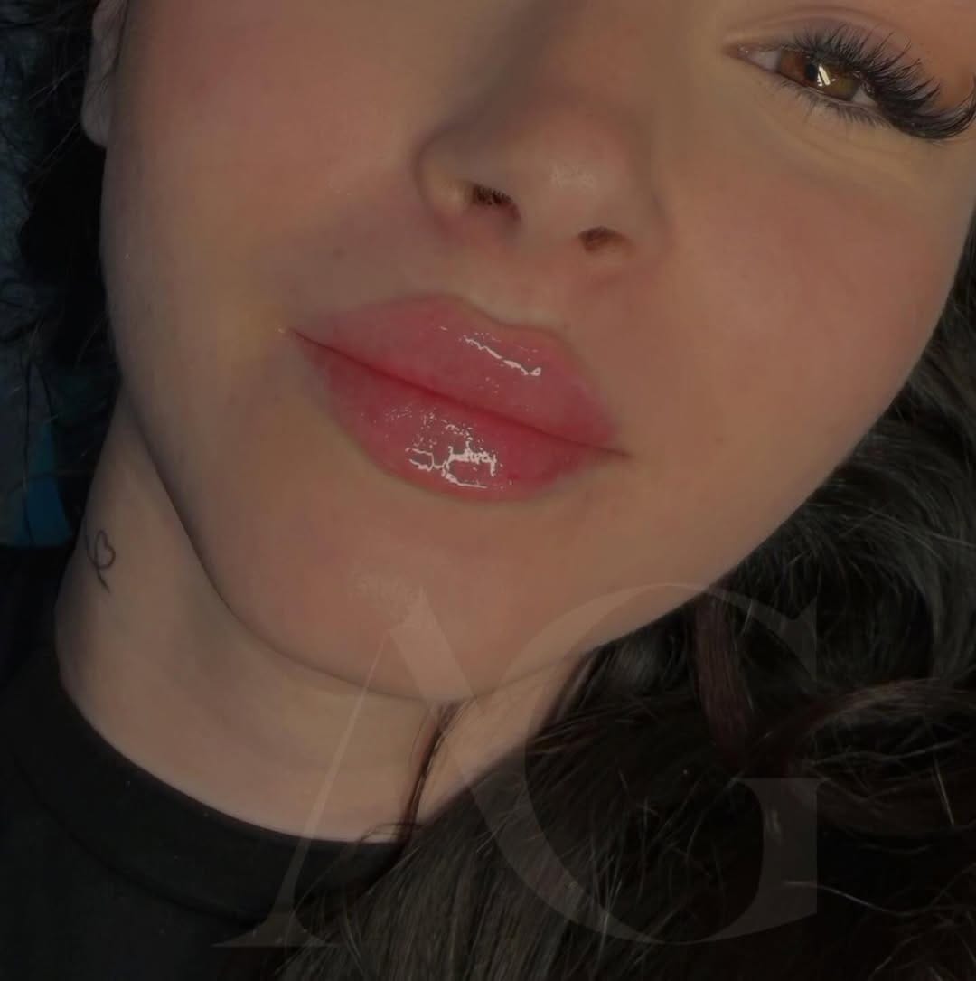 Post 2 by Dra.Anabella González • RUSSIAN LIPS 🇪🇸 on Instagram (carousel)