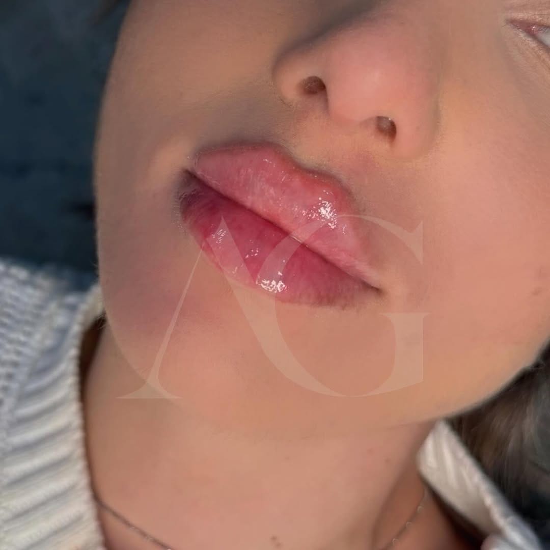Post 8 by Dra.Anabella González • RUSSIAN LIPS 🇪🇸 on Instagram (carousel)