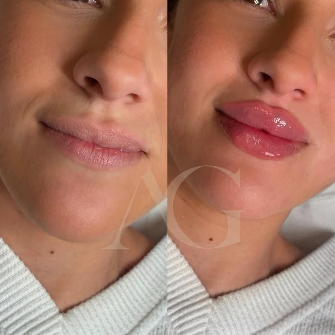 Post 1 by Dra.Anabella González • RUSSIAN LIPS 🇪🇸 on Instagram (image)