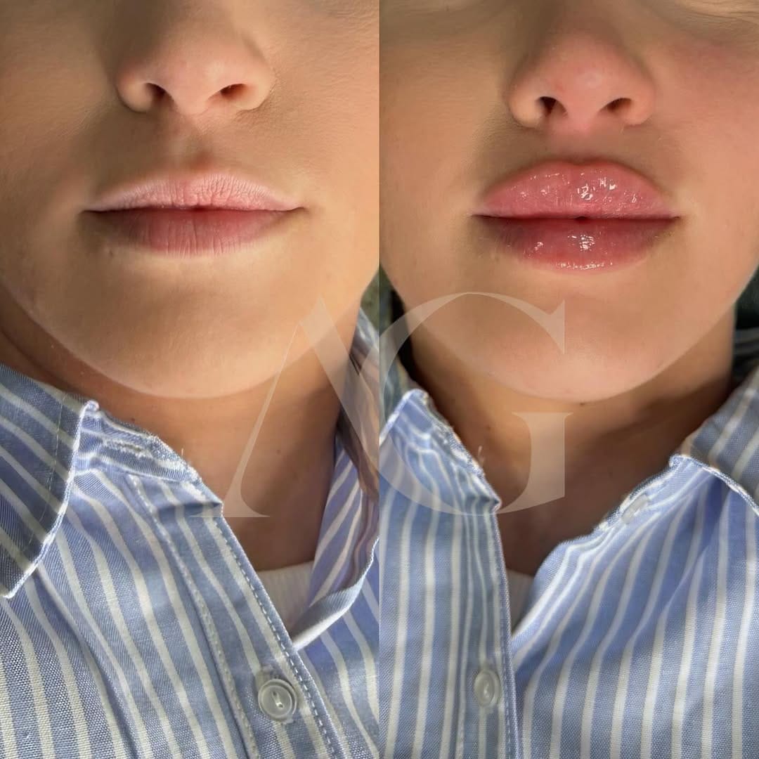 Post 6 by Dra.Anabella González • RUSSIAN LIPS 🇪🇸 on Instagram (image)