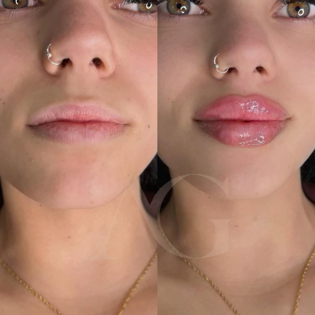 Post 5 by Dra.Anabella González • RUSSIAN LIPS 🇪🇸 on Instagram (image)
