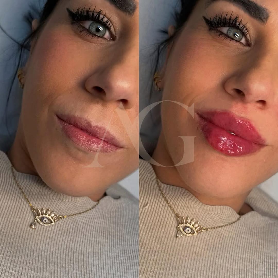 Post 7 by Dra.Anabella González • RUSSIAN LIPS 🇪🇸 on Instagram (carousel)