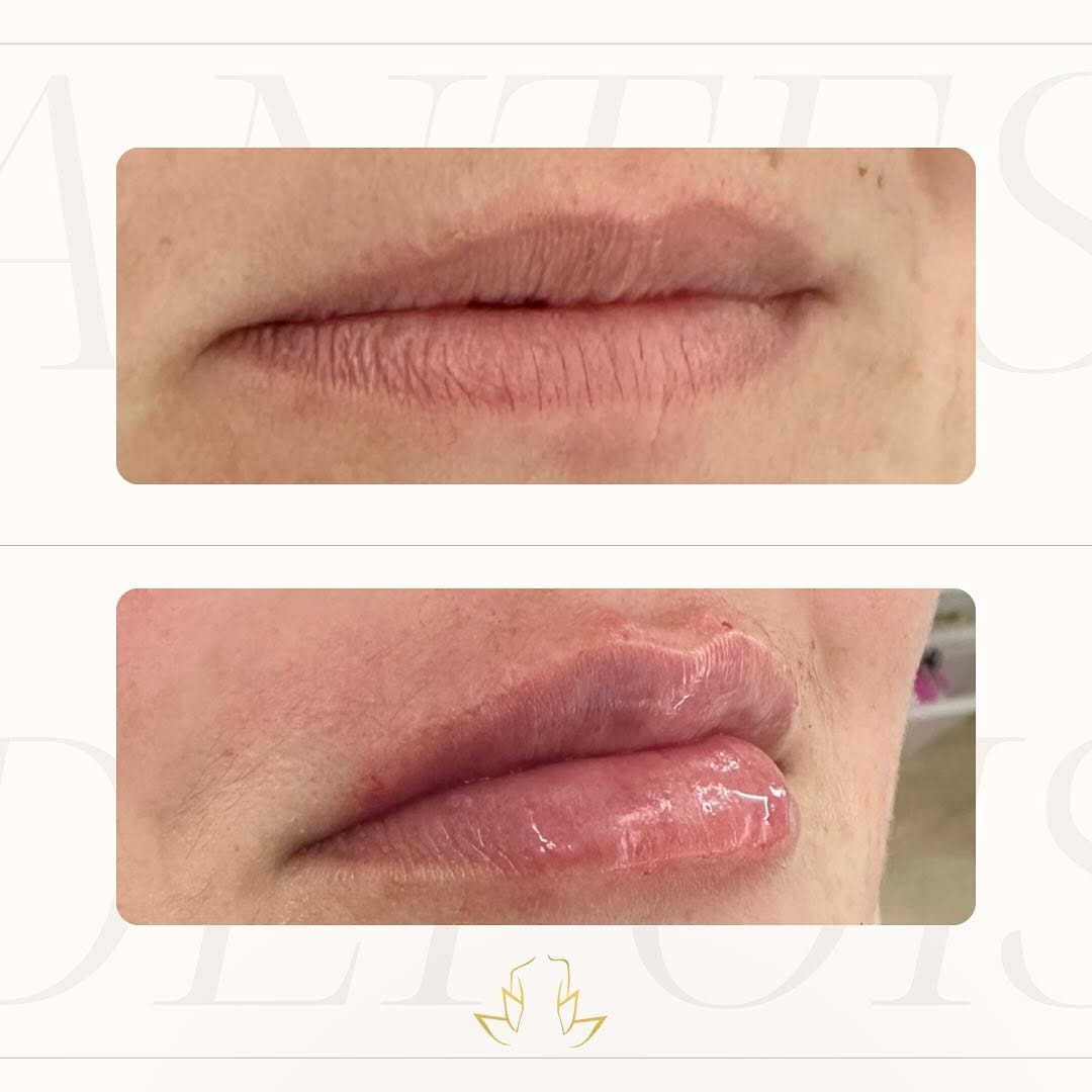 Post 9 by Bruna Tatagiba ❄️ CRIOMODELAGEM ♡ Estética Avançada on Instagram (image)