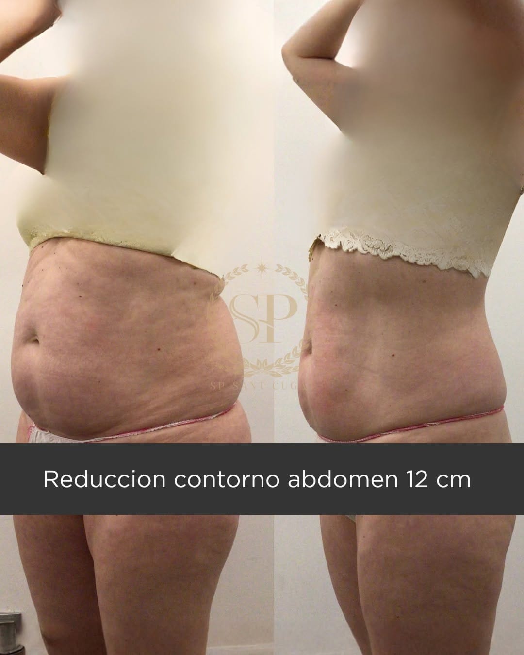 Post 4 by SP Sant Cugat | Centro Med. Estético | Estética Avanzada on Instagram (carousel)