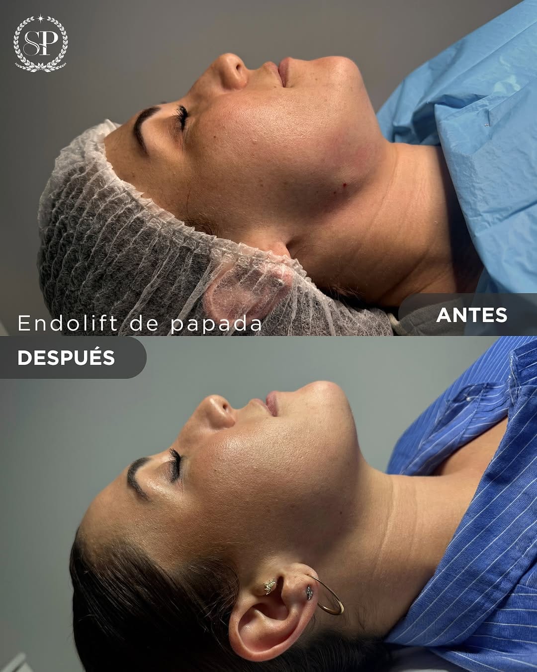 Post 10 by SP Sant Cugat | Centro Med. Estético | Estética Avanzada on Instagram (image)