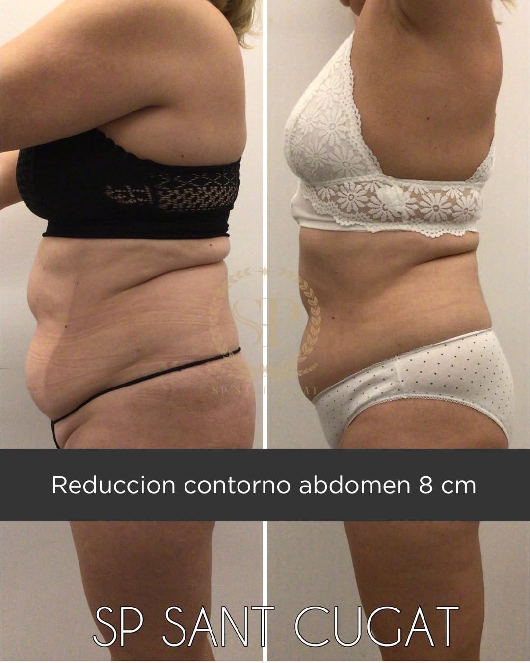 Post 2 by SP Sant Cugat | Centro Med. Estético | Estética Avanzada on Instagram (image)