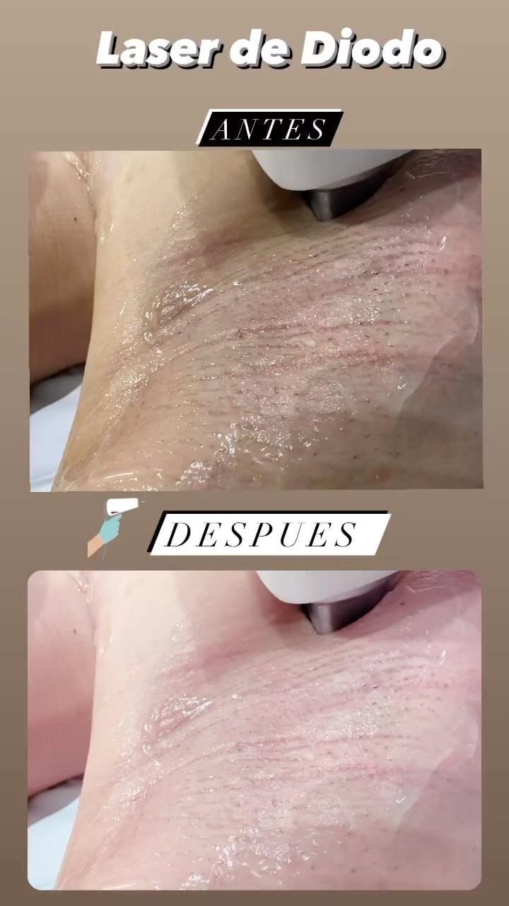 Post 5 by Aqua Laser Sculpt | Estética Avanzada on Instagram (video)