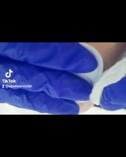 Post 10 by Aqua Laser Sculpt | Estética Avanzada on Instagram (video)