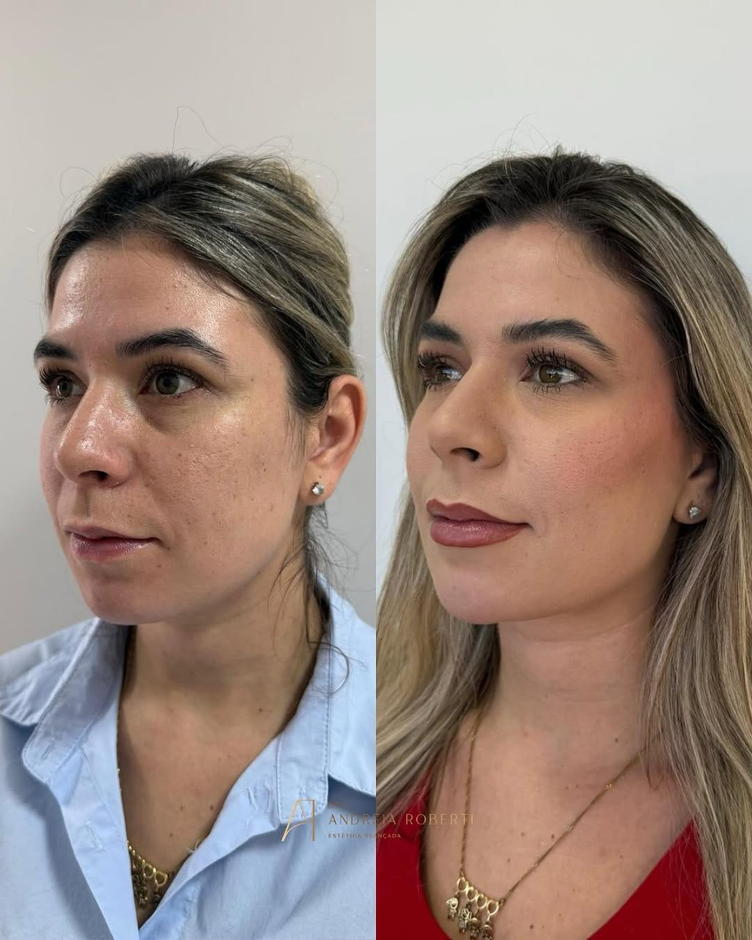 Post 9 by Dra. Andréia Roberti - Harmonização Facial on Instagram (image)