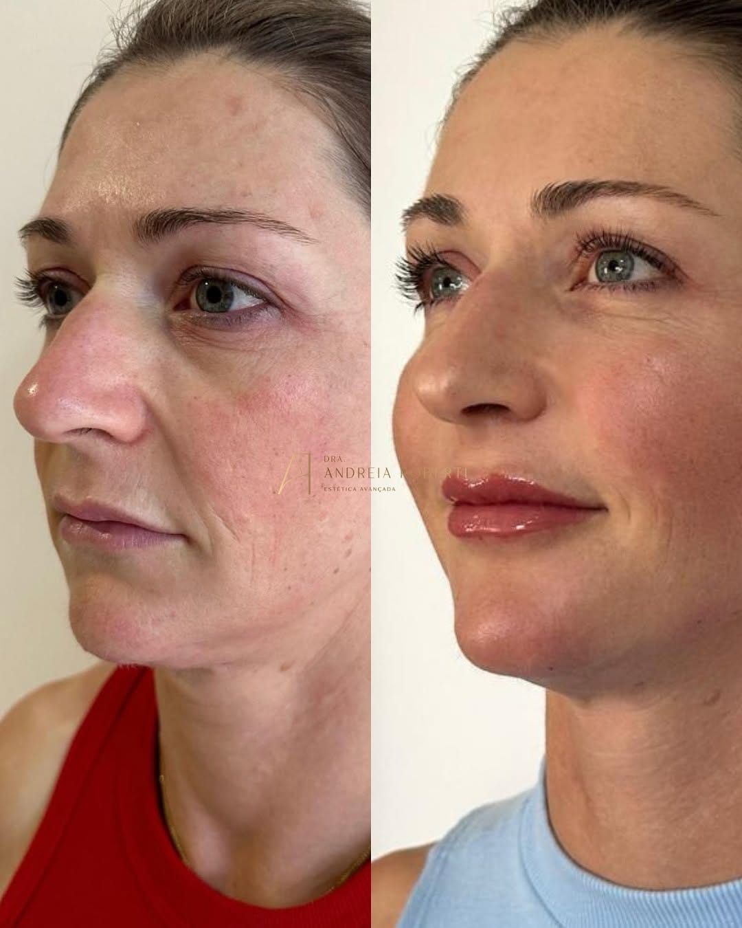 Post 8 by Dra. Andréia Roberti - Harmonização Facial on Instagram (carousel)