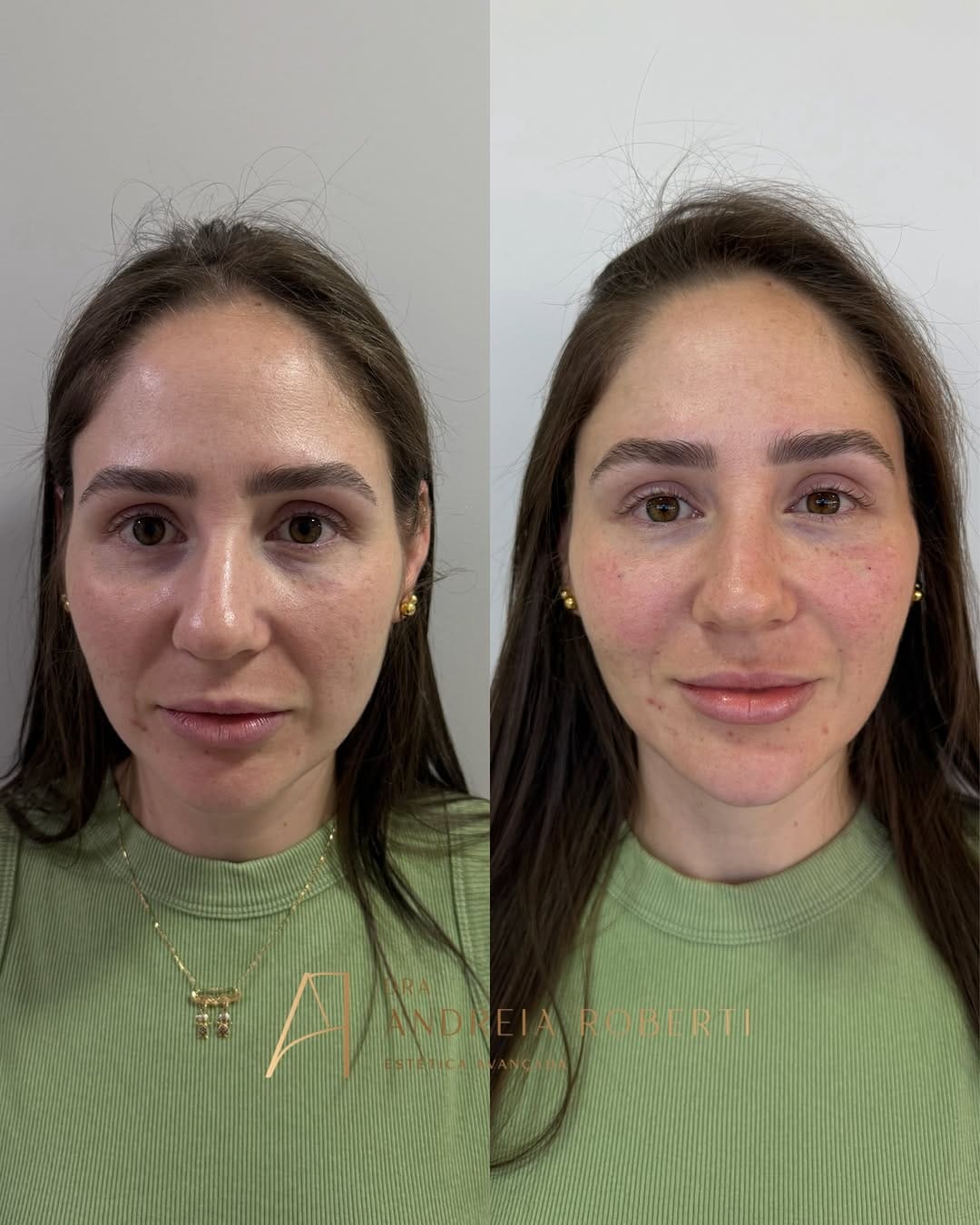 Post 2 by Dra. Andréia Roberti - Harmonização Facial on Instagram (carousel)