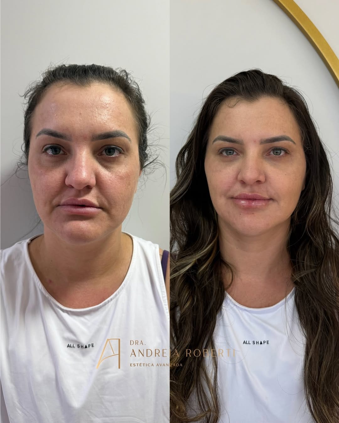 Post 5 by Dra. Andréia Roberti - Harmonização Facial on Instagram (carousel)