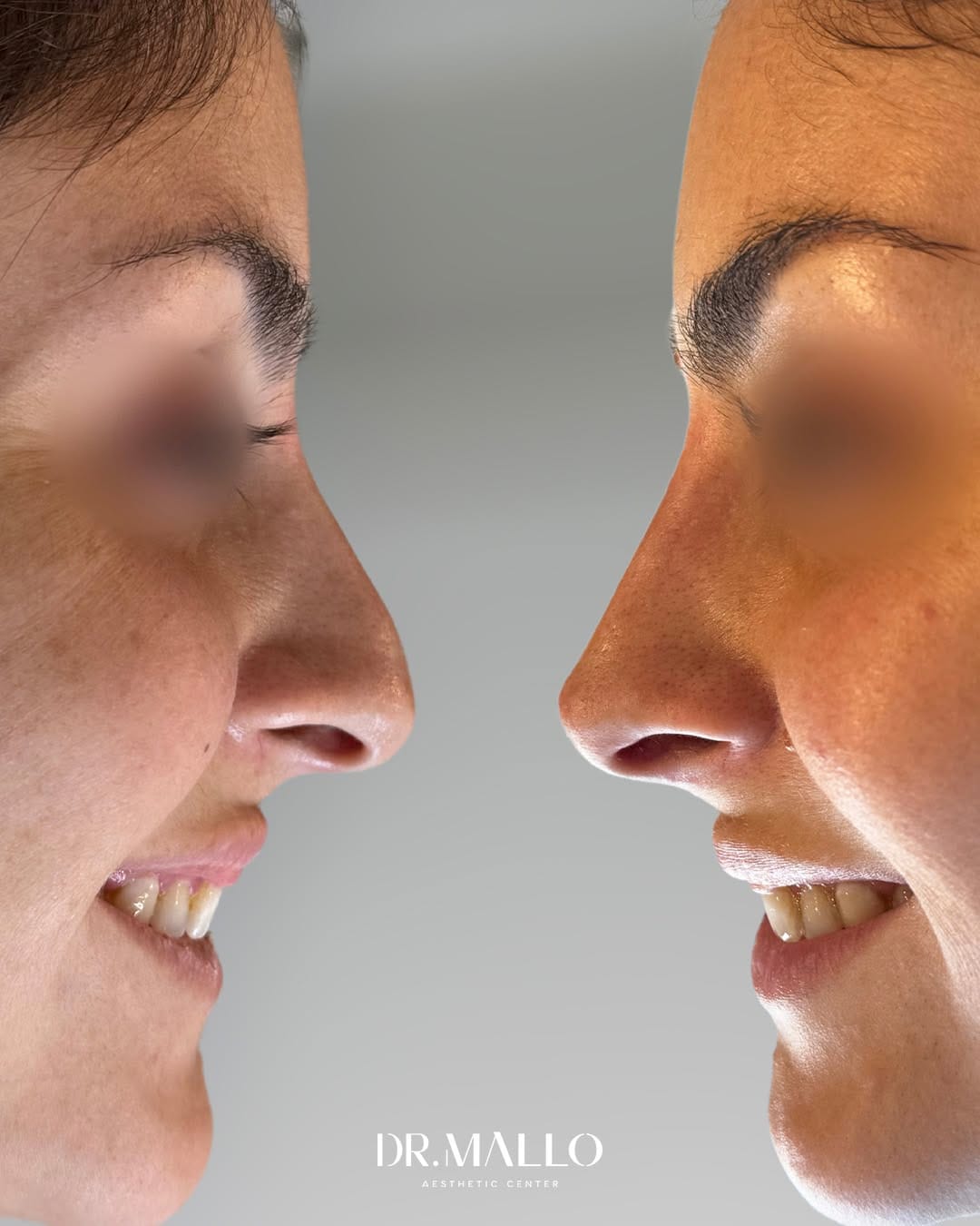 Post 10 by Dr. Alberto Mallo - Medicina Estética & Well Aging on Instagram (carousel)