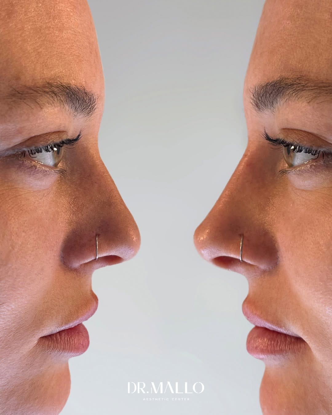 Post 4 by Dr. Alberto Mallo - Medicina Estética & Well Aging on Instagram (carousel)