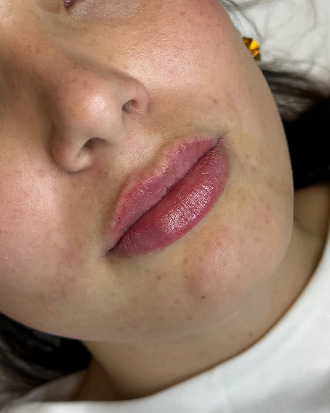 Post 6 by Dr. Alberto Mallo - Medicina Estética & Well Aging on Instagram (carousel)