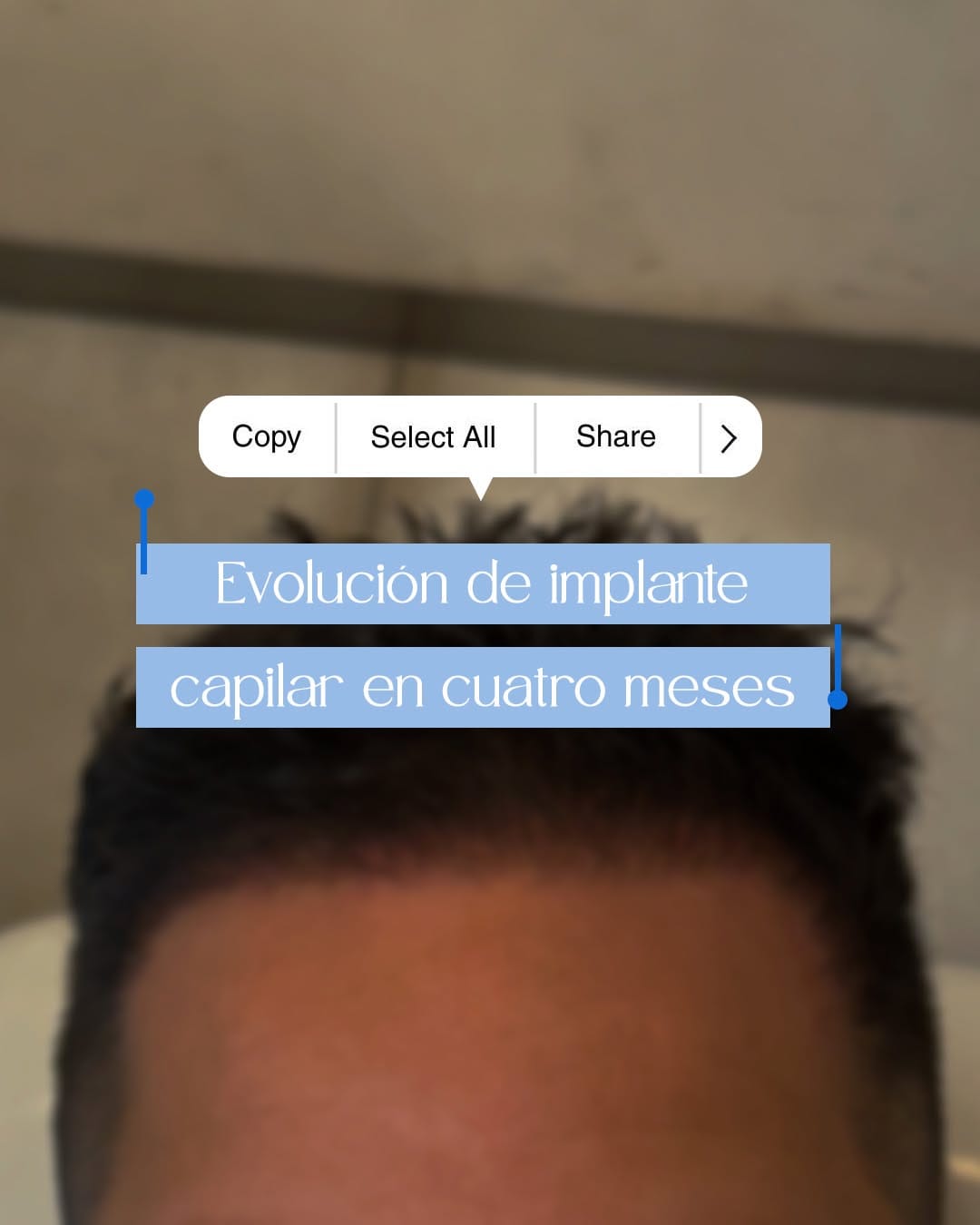 Post 8 by Dr. Alberto Mallo - Medicina Estética & Well Aging on Instagram (carousel)