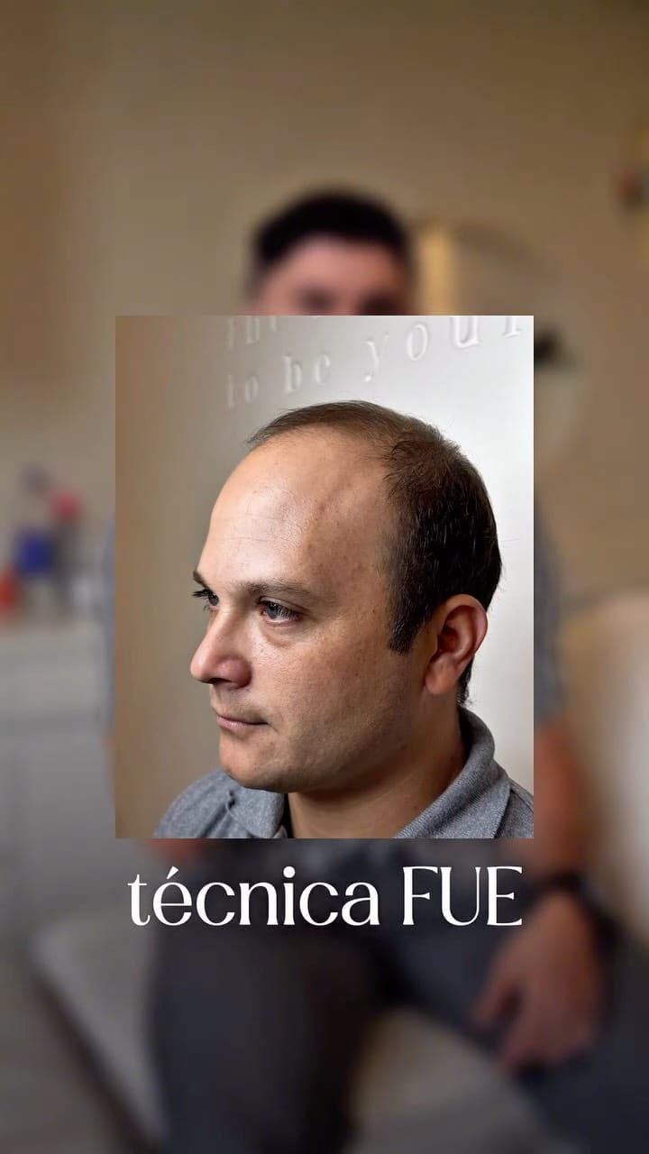Post 5 by Dr. Alberto Mallo - Medicina Estética & Well Aging on Instagram (video)