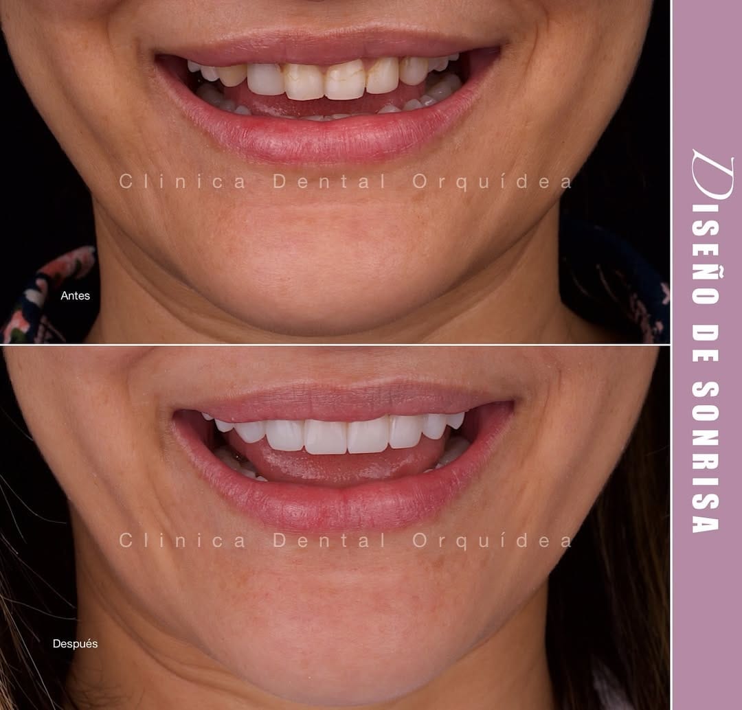Post 6 by Orquidea Dental 🇻🇪🇪🇸 on Instagram (image)