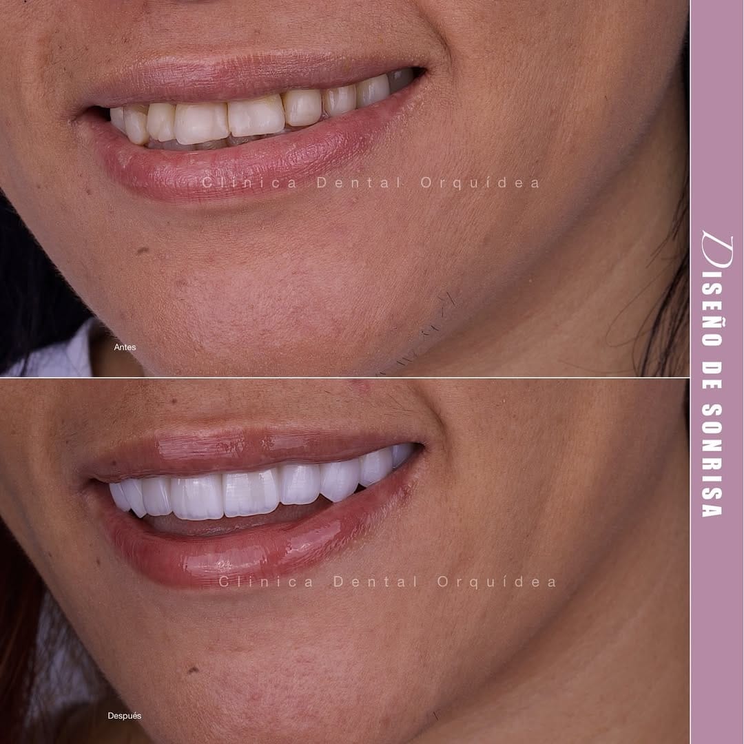 Post 4 by Orquidea Dental 🇻🇪🇪🇸 on Instagram (carousel)