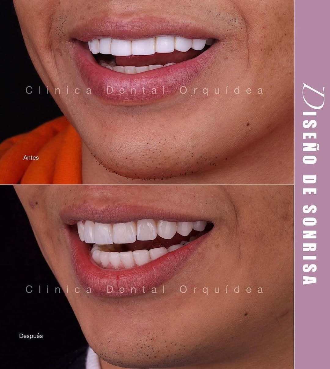 Post 10 by Orquidea Dental 🇻🇪🇪🇸 on Instagram (carousel)
