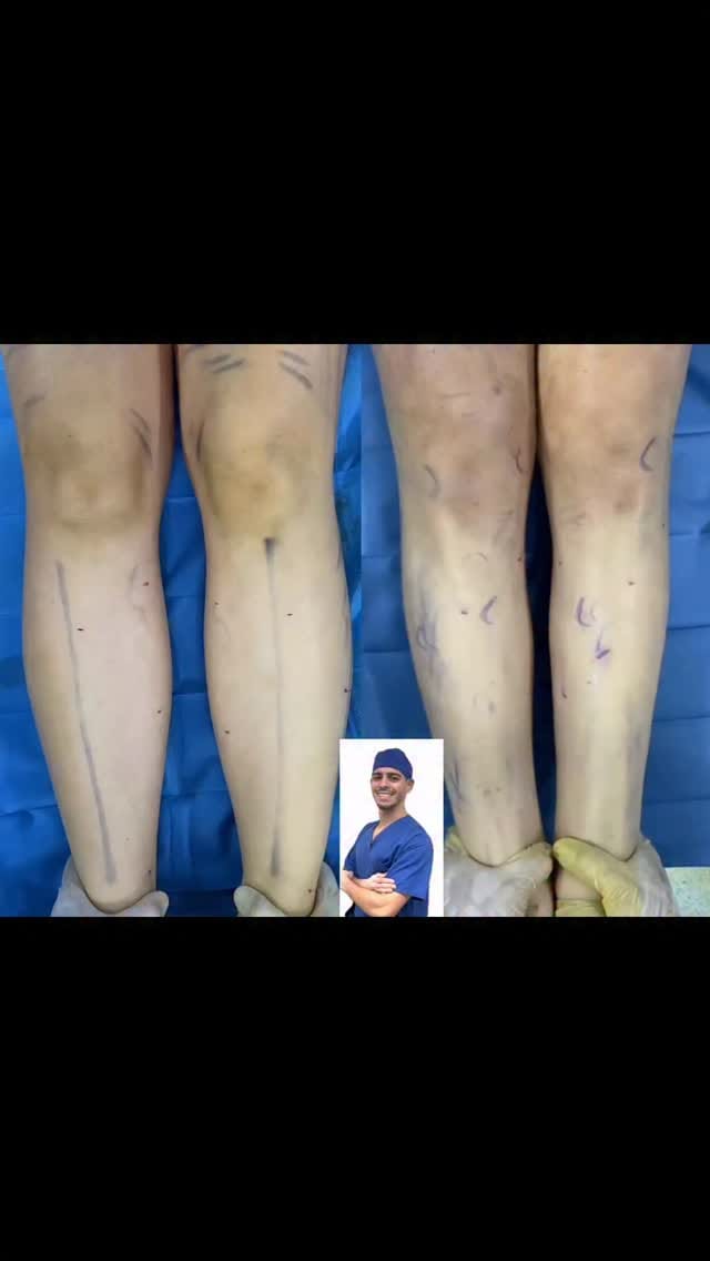 Post 1 by Dr. Burgos de la Obra - Lipemedical team on Instagram (video)
