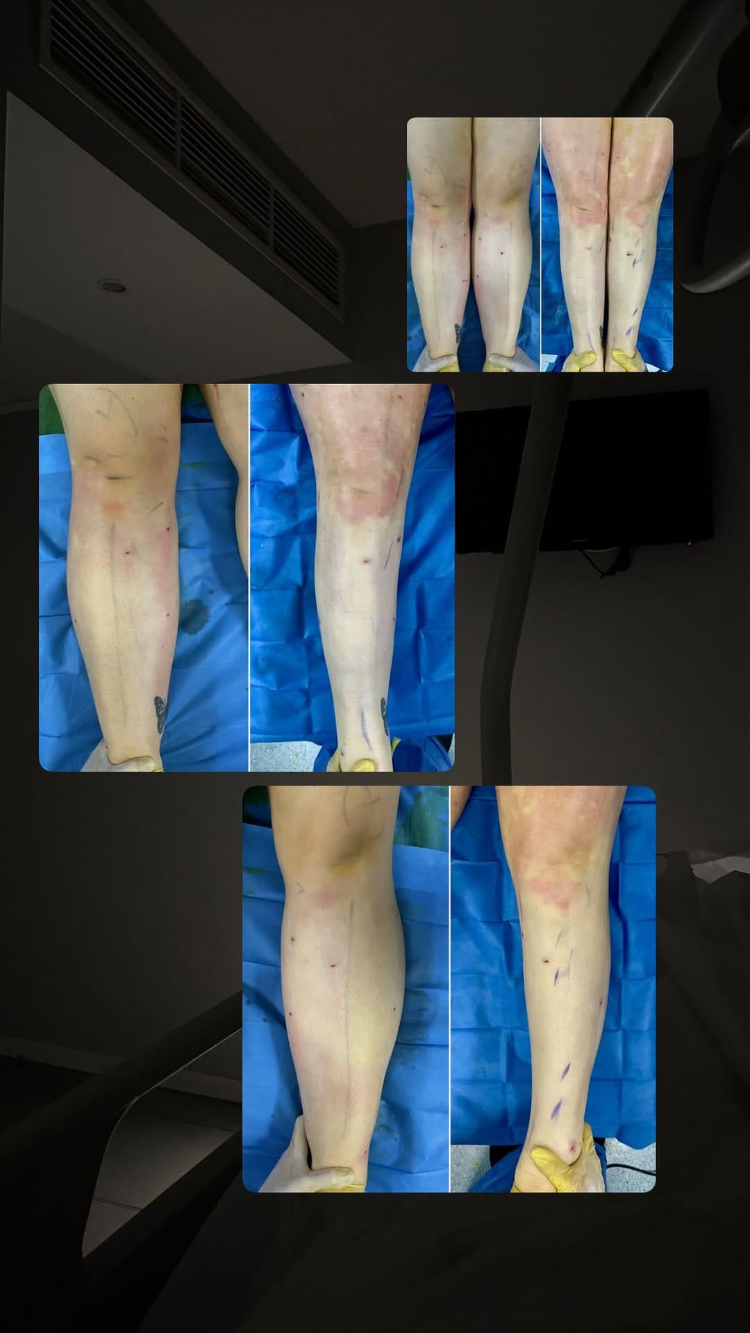 Post 8 by Dr. Burgos de la Obra - Lipemedical team on Instagram (video)