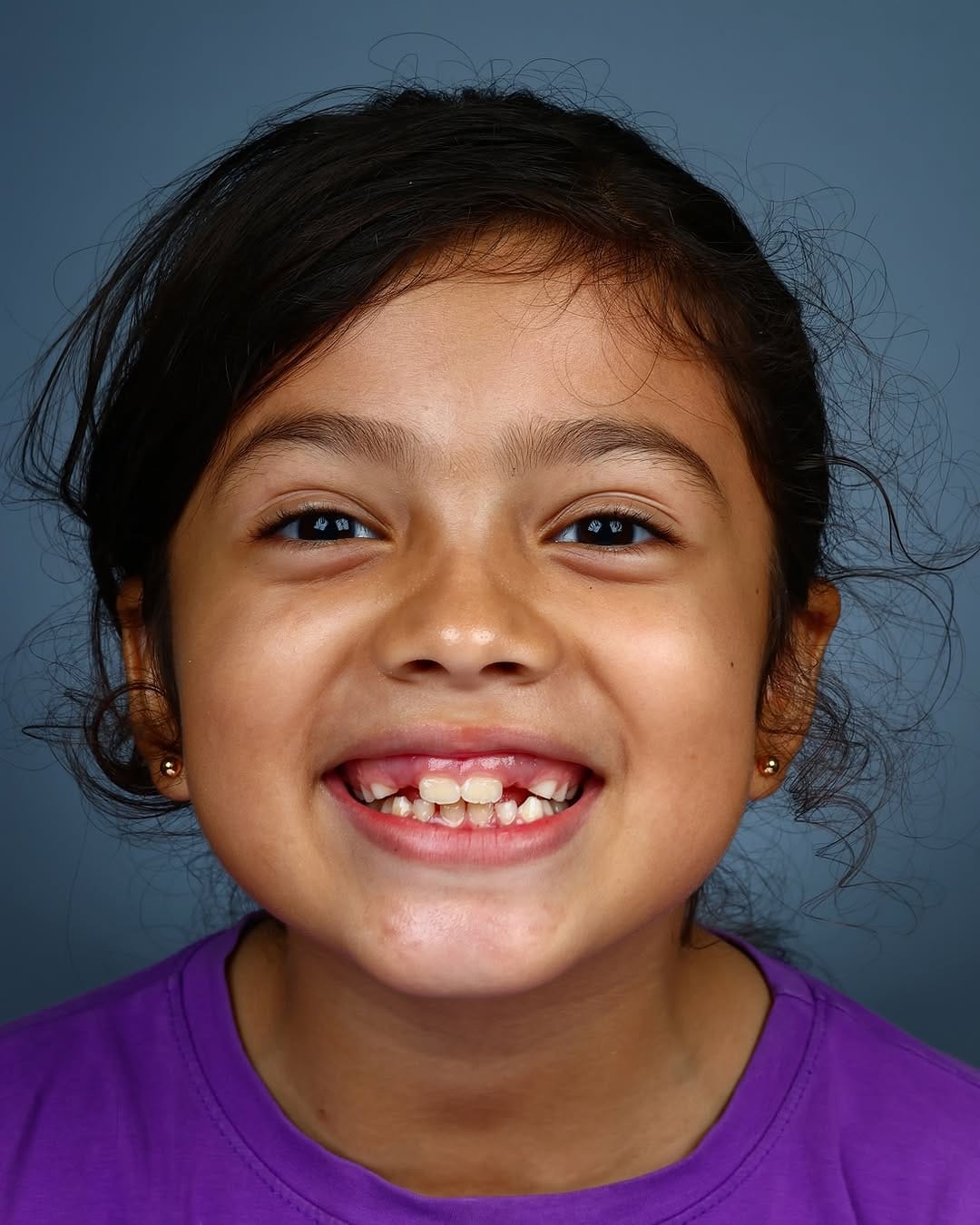 Post 10 by Miguel Madrid  | Odontólogo | Filosofía BOPT | Fotografía dental on Instagram (carousel)