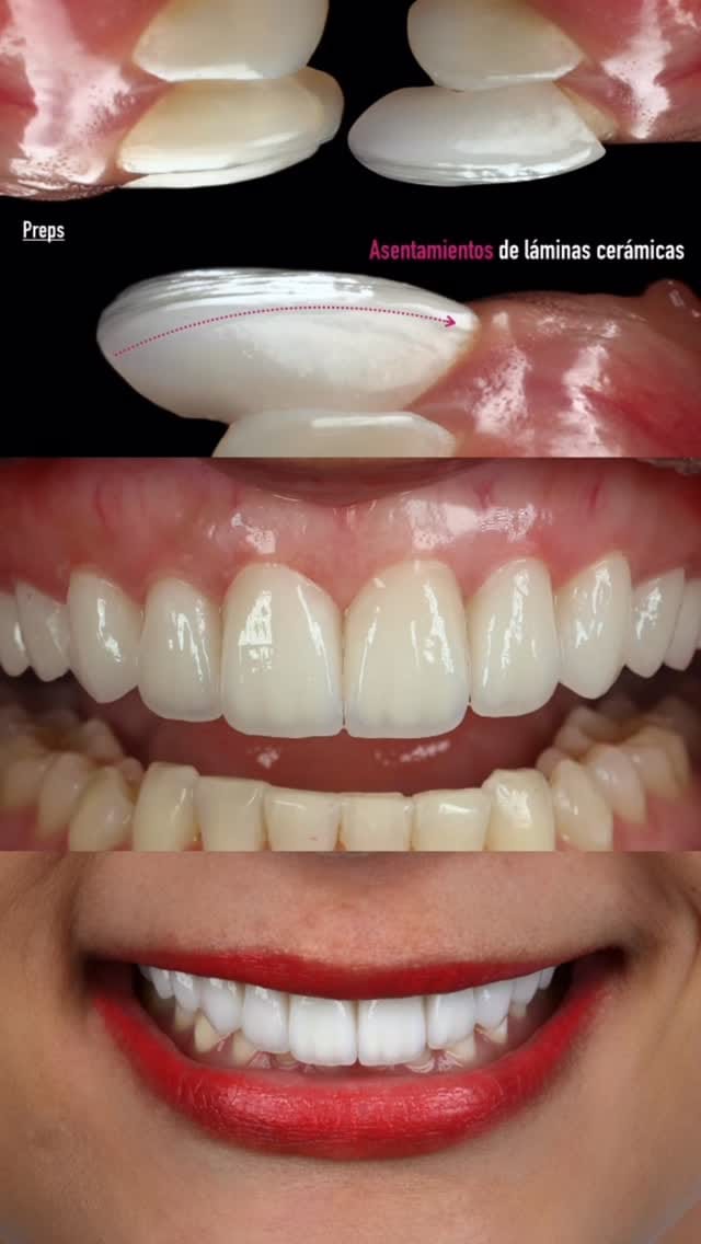 Post 8 by Miguel Madrid  | Odontólogo | Filosofía BOPT | Fotografía dental on Instagram (video)