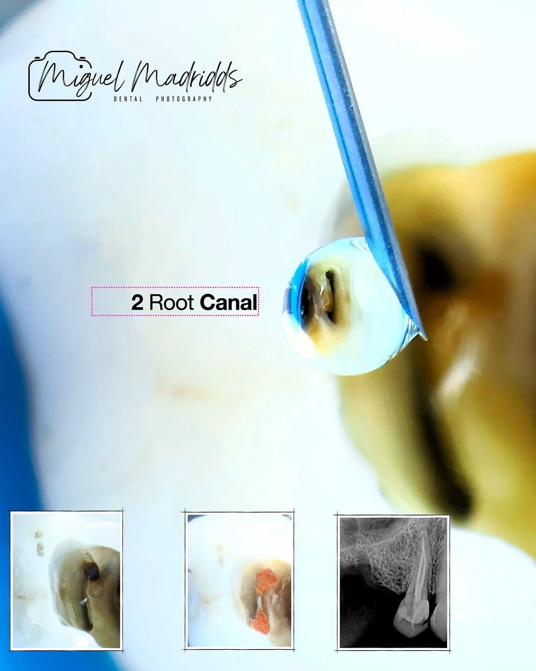 Post 5 by Miguel Madrid  | Odontólogo | Filosofía BOPT | Fotografía dental on Instagram (image)