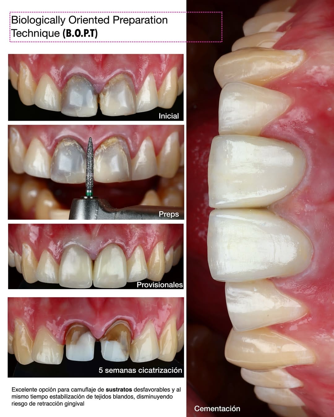 Post 2 by Miguel Madrid  | Odontólogo | Filosofía BOPT | Fotografía dental on Instagram (image)