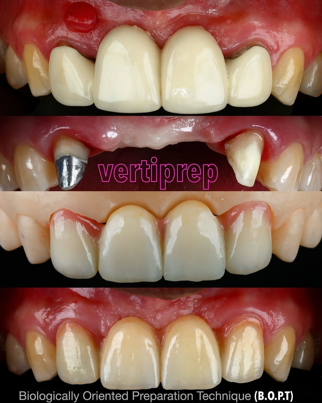 Post 3 by Miguel Madrid  | Odontólogo | Filosofía BOPT | Fotografía dental on Instagram (image)