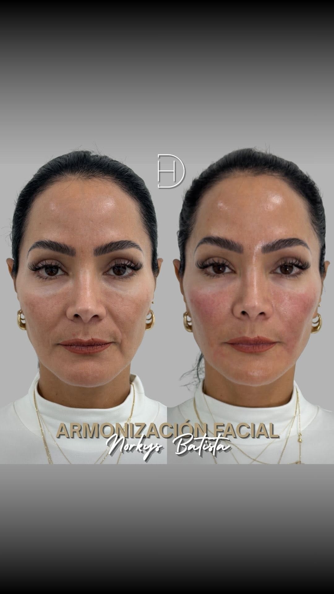 Post 6 by Dr. Deivys Higuerey / Medicina y Cirugía Estética on Instagram (video)