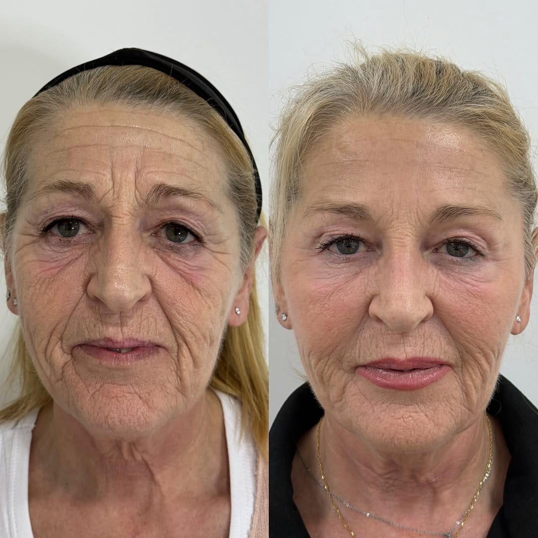 Post 3 by Dr. Deivys Higuerey / Medicina y Cirugía Estética on Instagram (image)