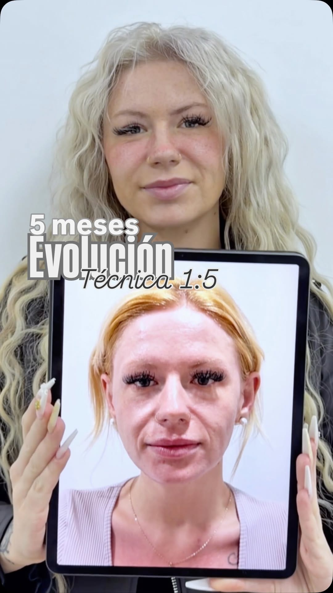 Post 5 by Dr. Deivys Higuerey / Medicina y Cirugía Estética on Instagram (video)