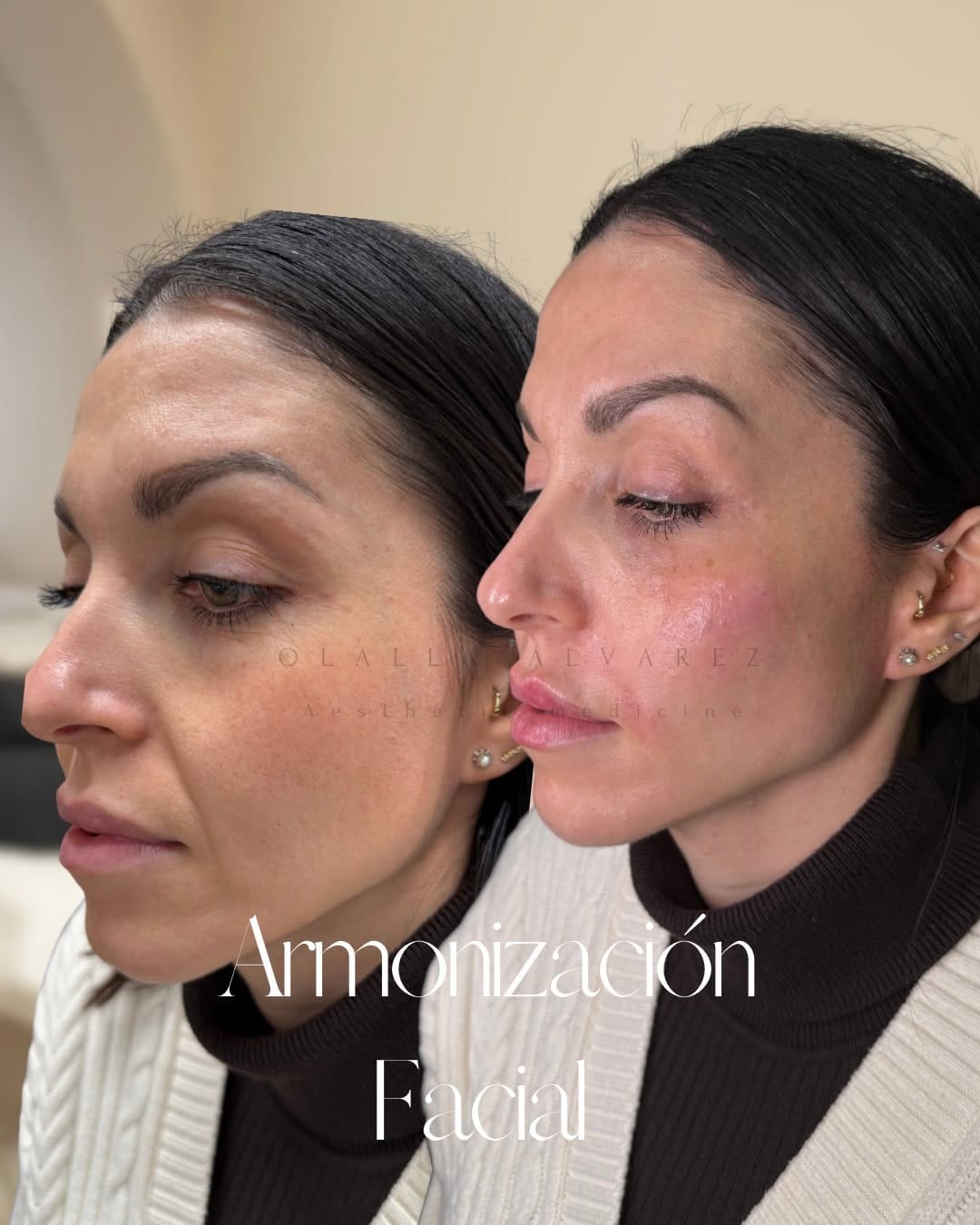 Post 4 by Clínica Olalla Álvarez Aesthetic Medicine | Art of Beauty on Instagram (carousel)