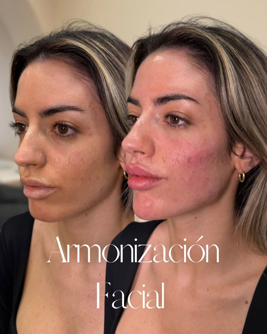 Post 8 by Clínica Olalla Álvarez Aesthetic Medicine | Art of Beauty on Instagram (carousel)