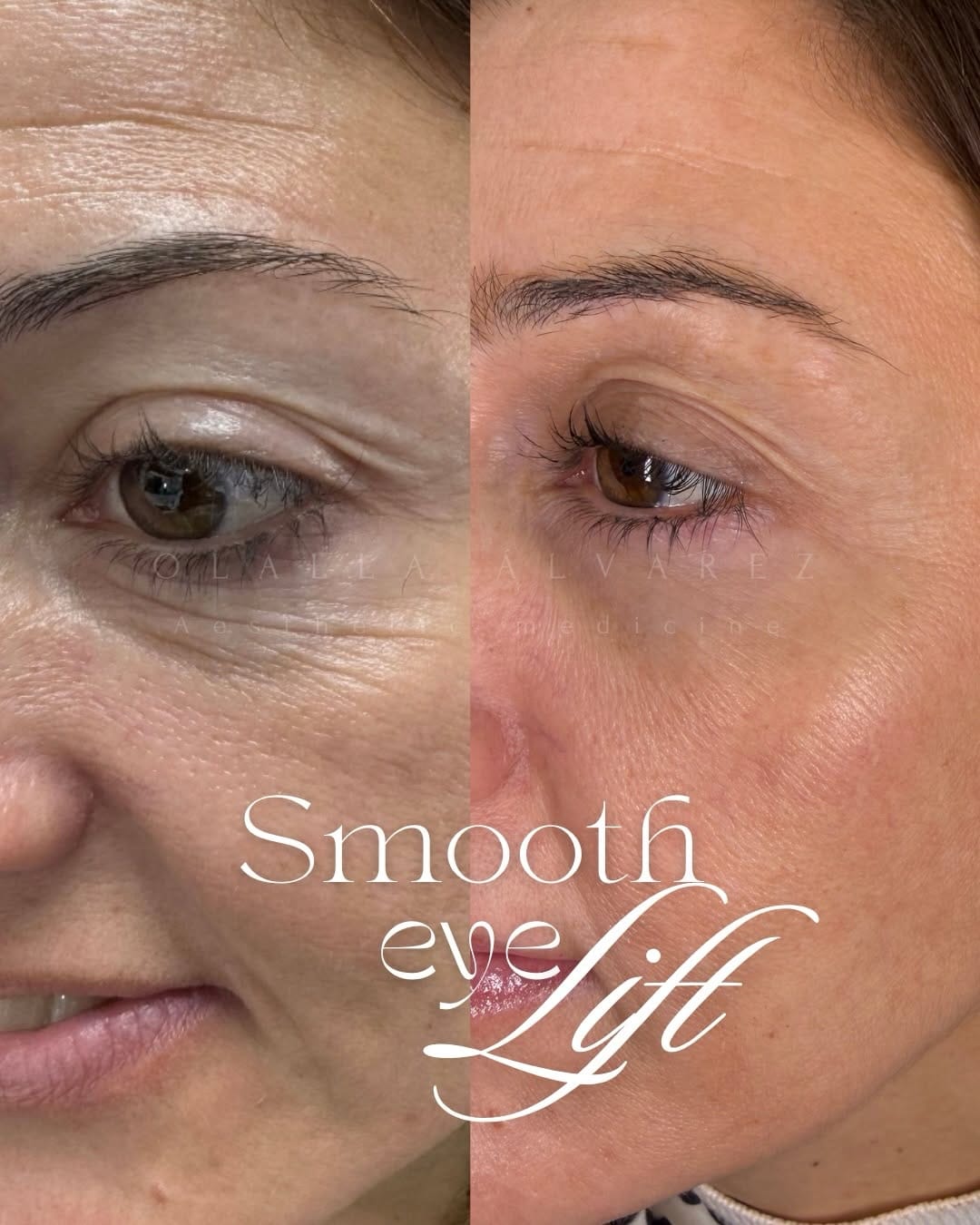 Post 6 by Clínica Olalla Álvarez Aesthetic Medicine | Art of Beauty on Instagram (carousel)