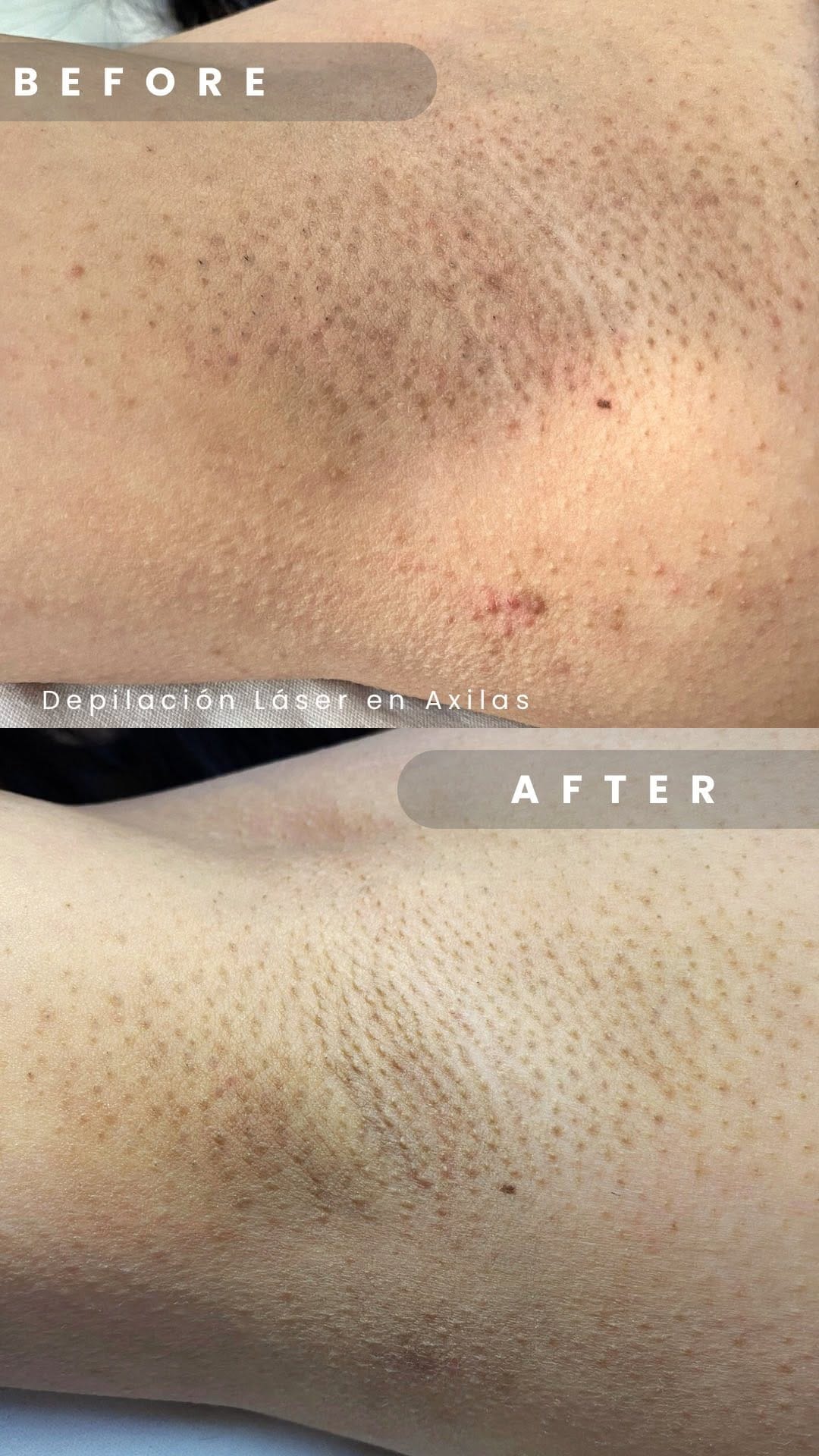 Post 5 by MACA Aesthetic & SPA |Depilación|Masajes| Post Operatorio on Instagram (video)
