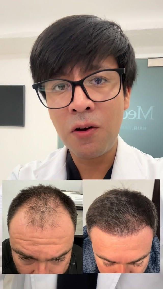 Post 2 by Transplante Capilar y Tricología on Instagram (video)