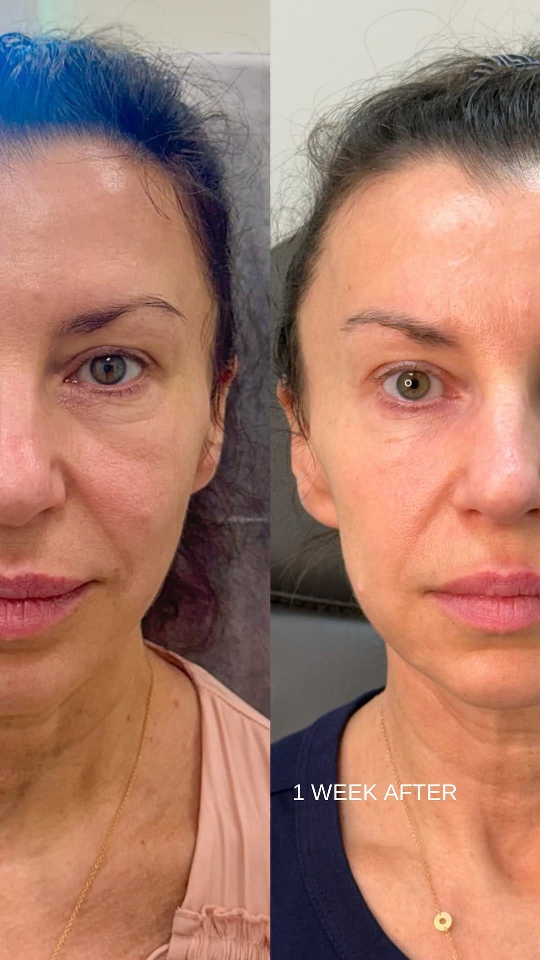 Post 10 by Gaia Mkrtchyan| Nurse Practitioner | Aesthetic Procedures on Instagram (video)