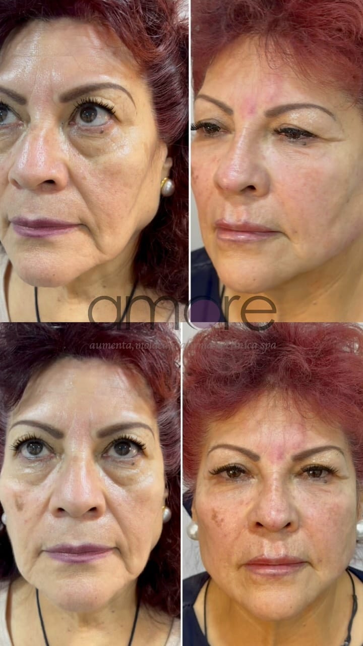 Post 8 by Amore Clinica y Spa on Instagram (video)